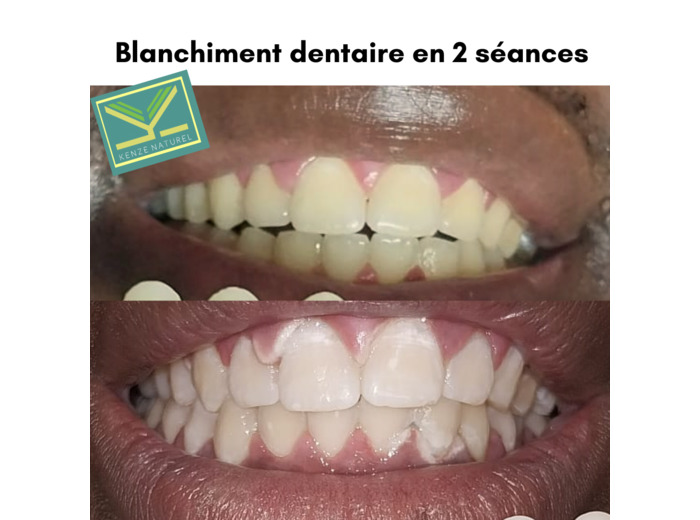 Blanchiment dentaire - 1séance - Éclaircissement