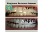 Blanchiment dentaire 2 séances