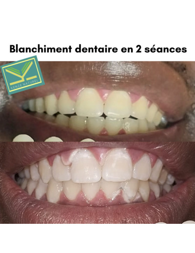 ECLAIRCISSEMENT DENTAIRE 1 séance TOURS CENTRE 37 100€