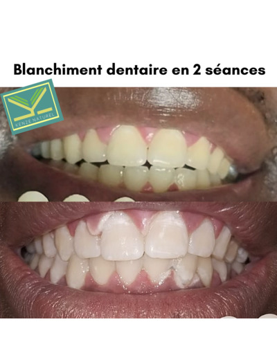Blanchiment dentaire - 1séance - Éclaircissement